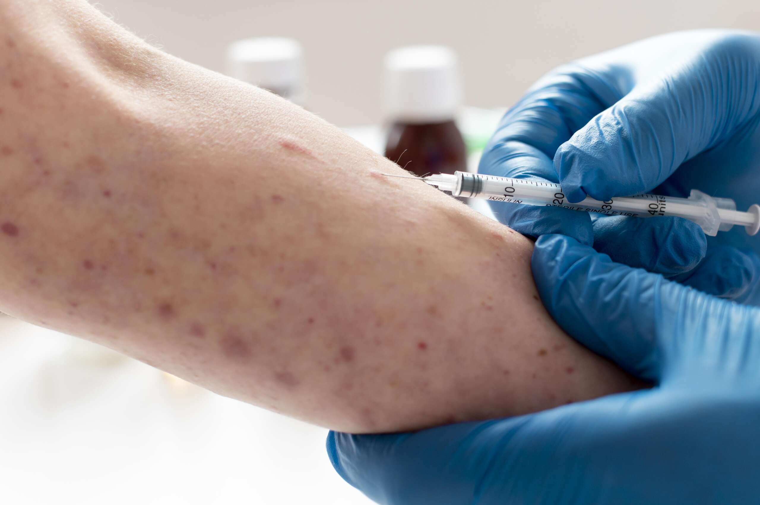 skin-allergy-person-s-arm (1)